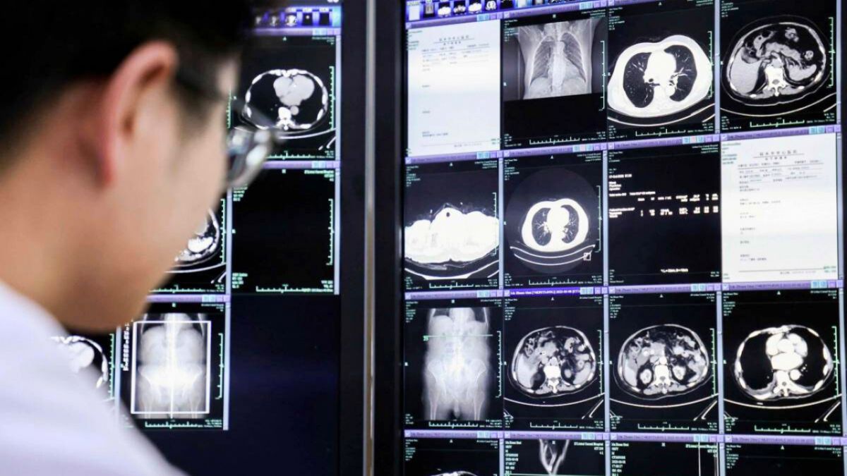 Alibaba AI pancreatic cancer detection