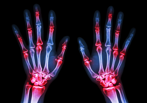 rheumatoid arthritis AI X-ray